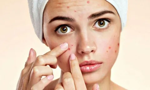 Học ngay bí quyết chăm sóc da mặt sau khi nặn mụn, giúp ngăn ngừa mụn tái phát