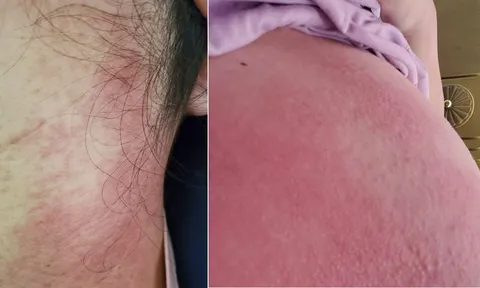 Làm đẹp sau sinh bằng rượu gừng, nghệ hạ thổ, bà mẹ trẻ bị viêm da toàn thân
