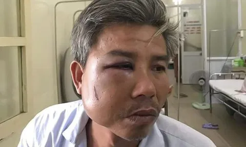 Khởi tố ông chủ quán "Bố già" đánh công nhân gãy quai hàm