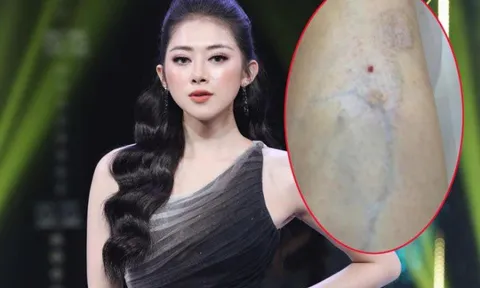 Từng teo cơ do tiêm thẩm mỹ, hot girl tái xuất làm bao chàng điên đảo