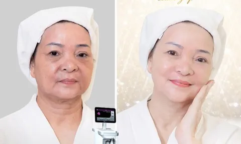 Tạm biệt làn da chạy xệ nhờ công nghệ “trẻ hóa Thermage FLX”