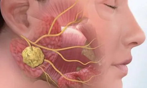 Nổi hạch cổ chớ coi thường bởi có thể là dấu hiệu của ung thư vòng họng