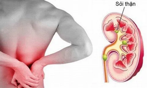 Những điều nên chú ý để phòng, tránh sỏi thận