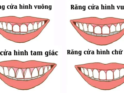 Nhìn tướng răng cửa dự đoán vận số: Tướng răng nào may mắn nhất?