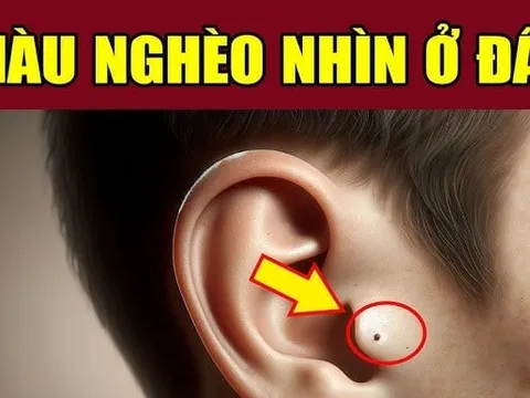 5 nốt ruồi giàu sang, ai sở hữu 1 cũng đủ phát tài may mắn hơn người