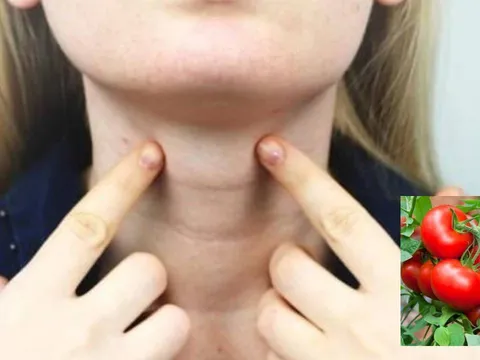 Số lượng u tuyến giáp ngày càng tăng nhanh, bác sĩ khuyên nên ăn ít hơn loại thực phẩm