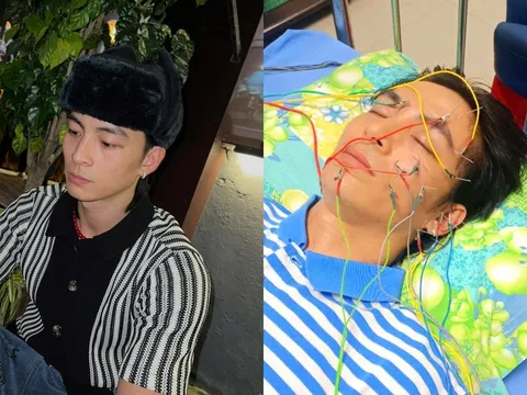 Thêm một nam thần màn ảnh Việt bị liệt dây thần kinh số 7, hình ảnh châm cứu khiến đồng nghiệp lo lắng