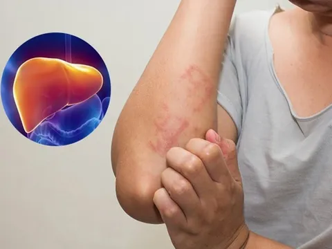 7 dấu hiệu cảnh báo bệnh gan đã đi vào giai đoạn nặng