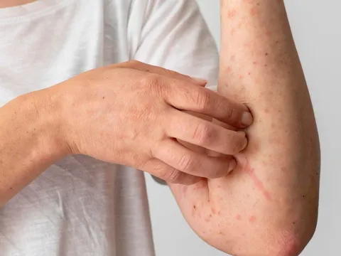 8 dấu hiệu cảnh báo bạn đang mắc bệnh thận giai đoạn nặng: Có 1 cũng nên đi khám gấp