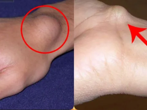 Sáng sớm thấy 4 dấu hiệu này là tế bào K đang tấn công, ăn mòn cơ thể