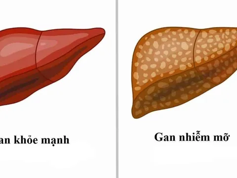 Gan nhiễm mỡ có gây ung thư gan? Chuyên gia cảnh báo dấu hiệu cần biết sớm
