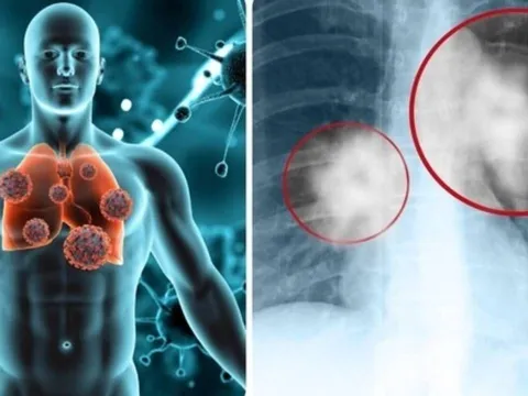 90% ca ung thư phổi ở nam giới Việt: Thói quen này là thủ phạm chính bạn cần biết!