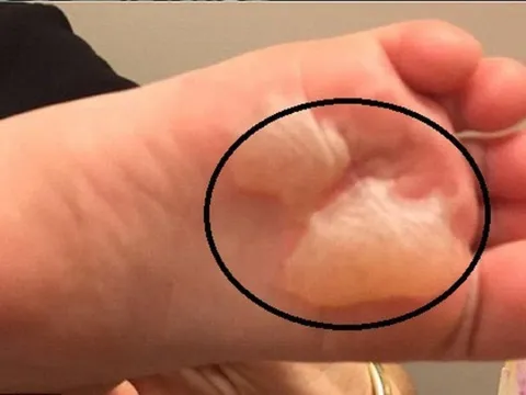 Cách chữa phồng rộp da chân khi đi bộ nhiều, mang giày chật