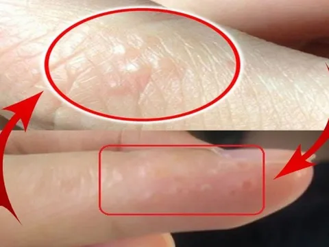 Tay  mọc mụn nước li ti có sao không?