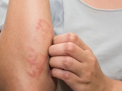 ５dấu hiệu cảnh báo bạn đang mắc bệnh thận giai đoạn nặng: Có 1 cũng nên đi khám sớm