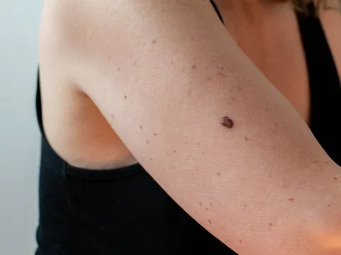 Cảnh báo: Đốm nhỏ trên da có thể là dấu hiệu ung thư – Đừng chủ quan