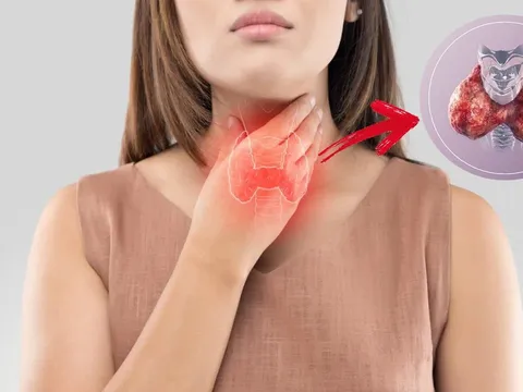 Ung thư tuyến giáp là mối đe dọa âm thầm: 6 có nhóm người dễ mắc bệnh này, nhất định phải thận trọng
