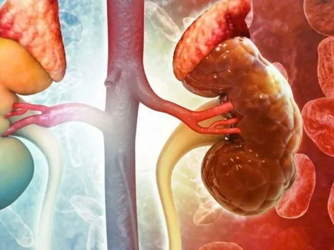 8 dấu hiệu cảnh báo suy thận giai đoạn đầu: Xem thường chạy thận cả đời