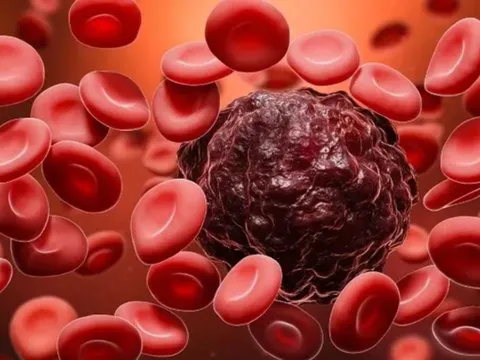 Xét nghiệm máu phát hiện ung thư sớm trước 3 năm