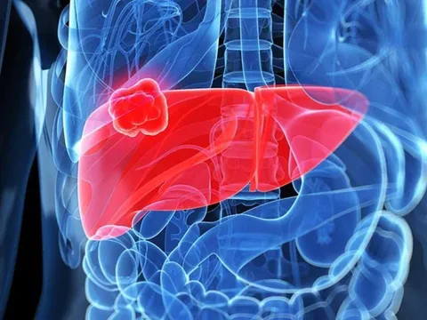 Buổi sáng có 5 dấu hiệu này cẩn thận suy gan, nhiều người chủ quan thiệt mạng