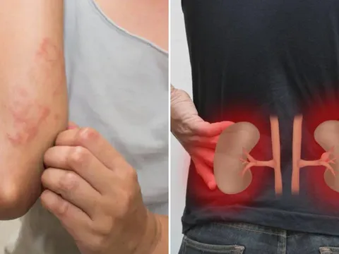 Cơ thể có 7 dấu hiệu này, cảnh báo bệnh thận, suy thận đang đến gần