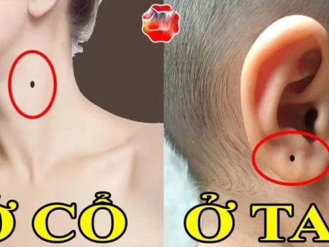 Những nốt ruồi Thần Tài 'đánh dấu', số 3 muốn nghèo cũng khó