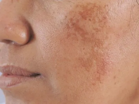 Bạn bị đốm đồi mồi, tàn nhang thường là do 3 điều này, hãy chủ ý đển chúng để có làn da đẹp