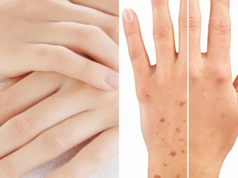 Mu bàn tay tiết lộ bí mật sống thọ: 4 dấu hiệu ai cũng nên kiểm tra