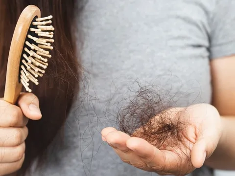 Rụng tóc mỗi ngày bao nhiêu là bình thường? 7 nguyên nhân gây rụng tóc và 5 cách 'cứu tóc' từ gốc