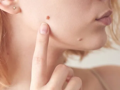 3 vị trí mọc nốt ruồi dễ thành ung thư da: Cảnh báo đừng xem thường