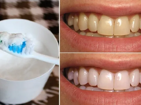 Đánh răng bằng thứ này, làm sạch mảng bám, tẩy trắng răng, không mòn men răng
