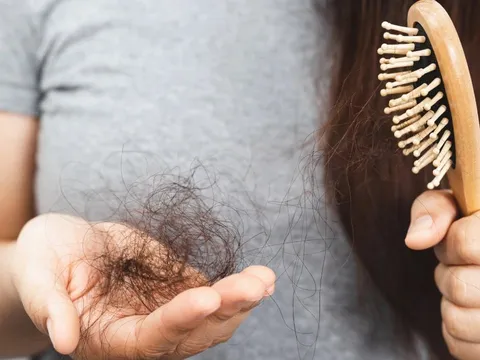 Càng ăn 5 loại thực phẩm này, tóc càng rụng nhiều: Món số 1 được nhiều người yêu thích