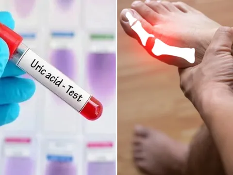 8 cách đơn giản giúp đào thải axit uric ra khỏi cơ thể, phòng ngừa bệnh gout
