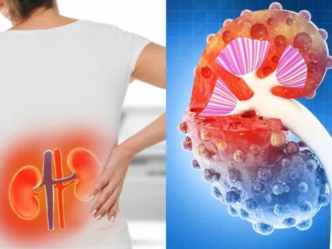8 dấu hiệu suy thận nhẹ bị nhiều người bỏ qua, chỉ tới lúc nặng mới biết