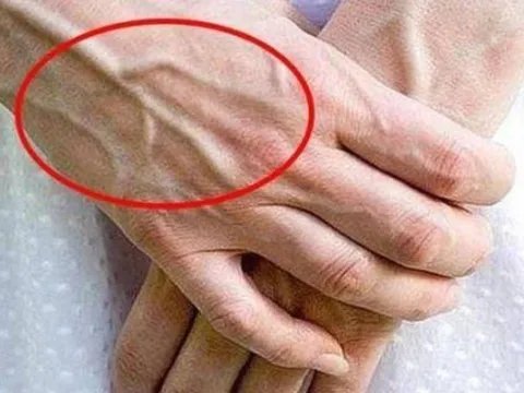 Vì sao tay xuất hiện gân xanh? Cẩn thận nếu bạn có ở những vị trí này!