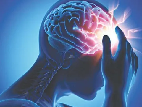 Dấu hiệu nhận biết đột quỵ trước 1 tuần là gì?