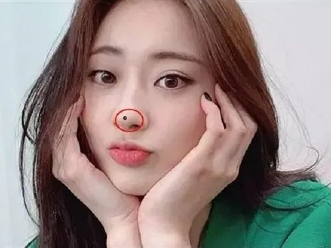 3 nốt ruồi chặn tài lộc: Ai không có thật đáng chúc mừng