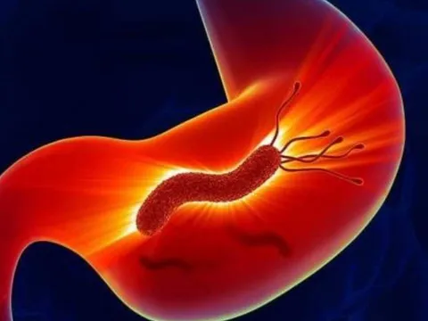 6 dấu hiệu tưởng nhẹ nhưng là "mồi nhử" ung thư: Đừng chủ quan nếu bạn mắc phải