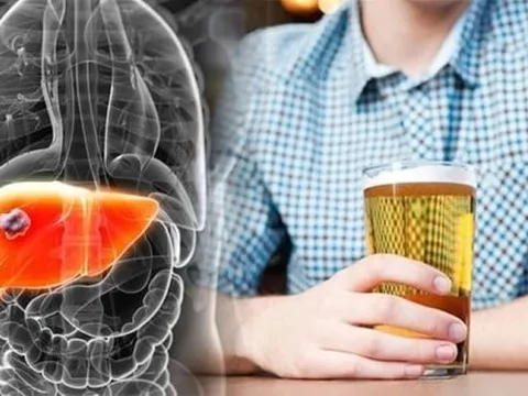 Uống cốc nước này tưởng lành mạnh nhưng đang phá nát gan, ngon mấy cũng đừng tiếc