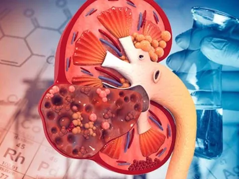 5 dấu hiệu cảnh báo suy thận sớm, nhiều người chủ quan bảo sao chạy thận cả đời