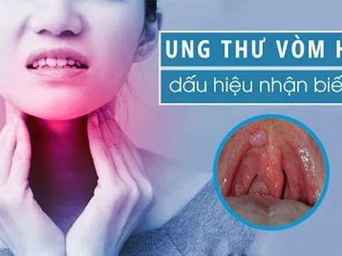 7 dấu hiệu K vòm họng: Số 1 không biết sớm khó mà chữa