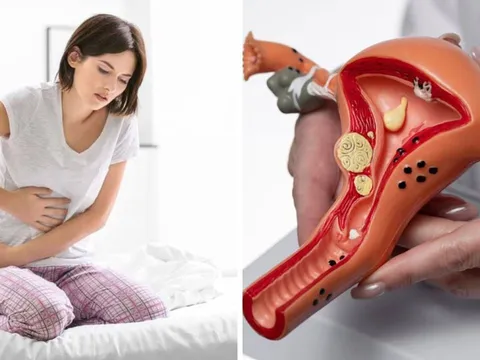 Dấu hiểu cảnh báo K cổ tử cung sớm: Phụ Nữ u 40 đang khoẻ mạnh cũng chớ xem thường