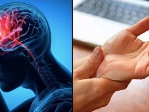 Dấu hiệu cảnh báo đột quỵ trước một tuần tuyệt đối đừng bỏ qua
