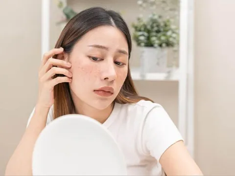 6 thói quen phổ biến khiến nám da ngày càng nặng hơn