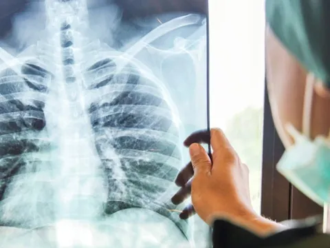 Vợ sống lành mạnh nhưng vẫn mắc K phổi giai đoạn cuối, nghi do một thói quen xấu của chồng
