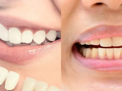 Nhìn màu răng đoán bệnh: Bác sĩ cảnh báo dấu hiệu nguy hiểm nhiều người bỏ qua