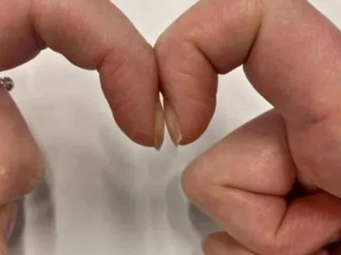 4 dấu hiệu bất thường trên ngón tay cảnh báo sớm ung thư gan, phổi