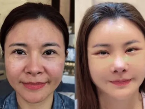 Kim Oanh lên tiếng sau khi gây tranh cãi vì phẫu thuật thẩm mỹ cả gương mặt
