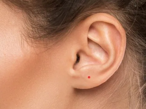 Nốt ruồi son là gì? Giải mã nốt ruồi son ở từng vị trí trên cơ thể