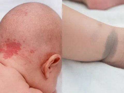 Cảnh báo: Những dấu hiệu 'nốt ruồi son - bớt - vết chàm' trên trẻ có thể tiềm ẩn nguy cơ bệnh lý